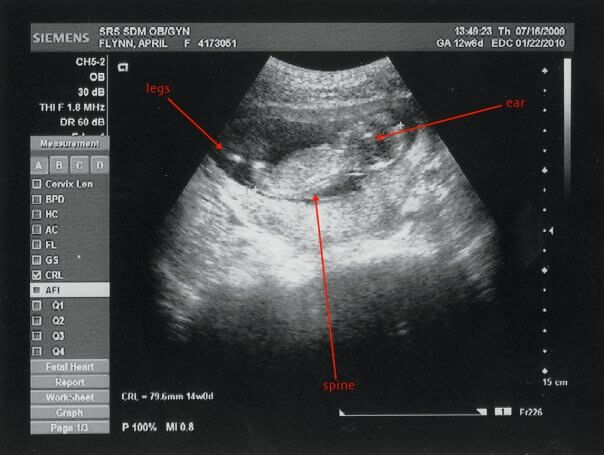 Ultrasound of Baby Flynn