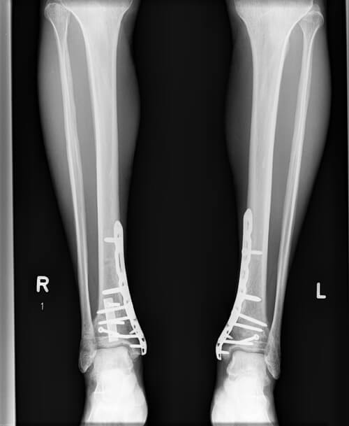Xray of legs with metal bracket and pins in ankles